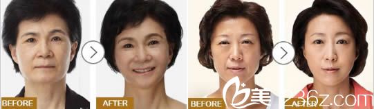 張水金面部除皺前后對比效果圖 張水金面部除皺前后對比效果圖