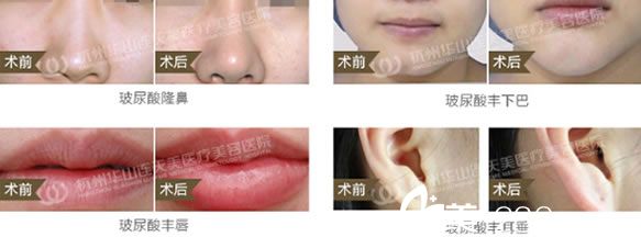 注射玻尿酸塑形案例圖 注射玻尿酸塑形案例圖