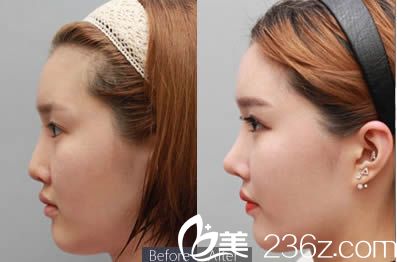 張水金醫(yī)生隆鼻案例 張水金醫(yī)生隆鼻案例