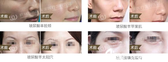 注射玻尿酸填充案例圖 注射玻尿酸填充案例圖