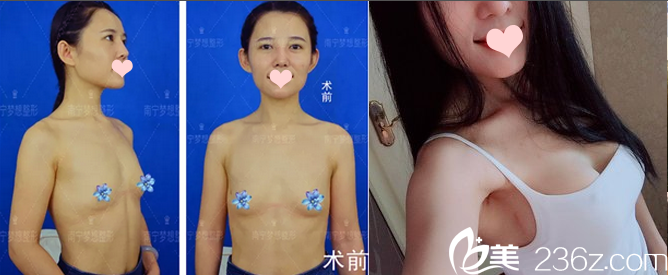 南寧夢想唐超內(nèi)窺鏡假體隆胸案例對(duì)比圖 南寧夢想唐超內(nèi)窺鏡假體隆胸案例對(duì)比圖