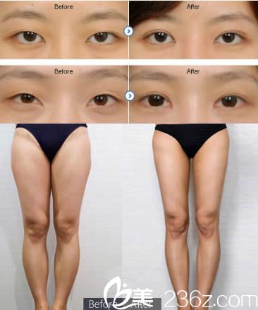 黃惠銘雙眼皮和大腿吸脂案例