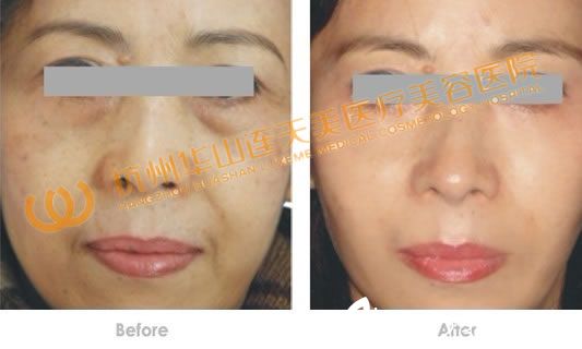 RF除皺緊膚技術(shù)案例效果 RF除皺緊膚技術(shù)案例效果