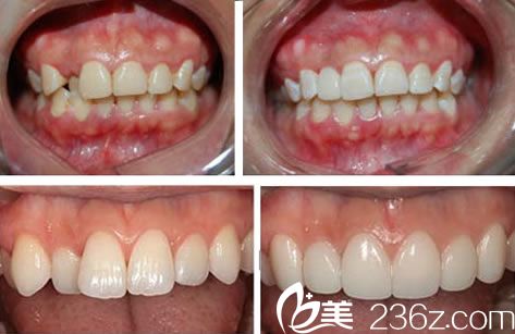 全瓷牙修復(fù)的效果圖
