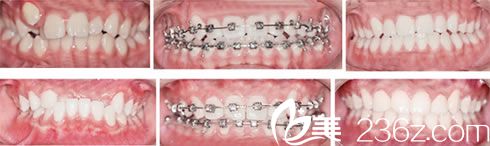 直絲弓矯正牙畸形的效果 直絲弓矯正牙畸形的效果