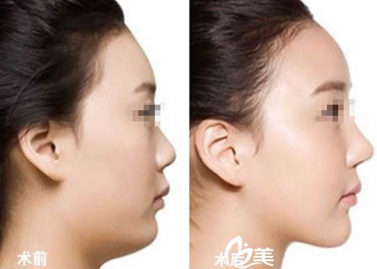 崔相哲醫(yī)生注射隆鼻案例圖 崔相哲醫(yī)生注射隆鼻案例圖