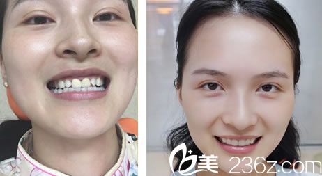 徐學(xué)忠醫(yī)生的牙冠修復(fù)案例