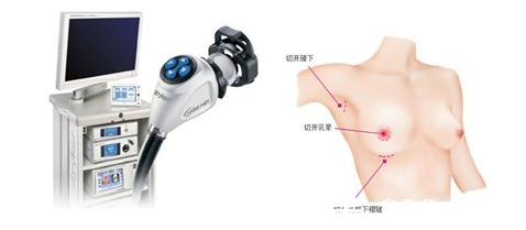 韓國(guó)麥恩醫(yī)院隆胸手術(shù)切口