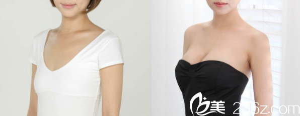 南寧夢想黎洪棉假體隆胸案例 南寧夢想黎洪棉假體隆胸案例