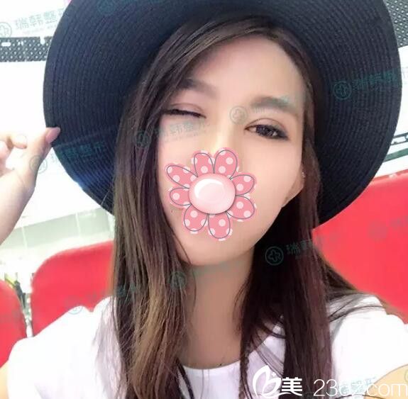 自體脂肪面部填充+雙眼皮術(shù)后 自體脂肪面部填充+雙眼皮術(shù)后