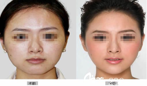 辜麗萍醫(yī)生注射瘦臉對(duì)比案例圖