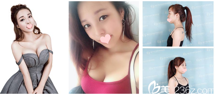 南寧東方整形醫(yī)院假體隆胸案例 南寧東方整形醫(yī)院假體隆胸案例