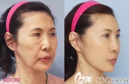 路世敏面部線雕案例圖 路世敏面部線雕案例圖