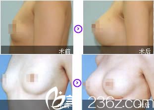 盛宗順假體隆胸案例