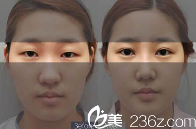 盛宗順醫(yī)生雙眼皮前后對比圖