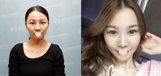 廣<!--<i data=20240709-sp></i>-->寧東方雙眼皮案例 廣<!--<i data=20240709-sp></i>-->寧東方雙眼皮案例