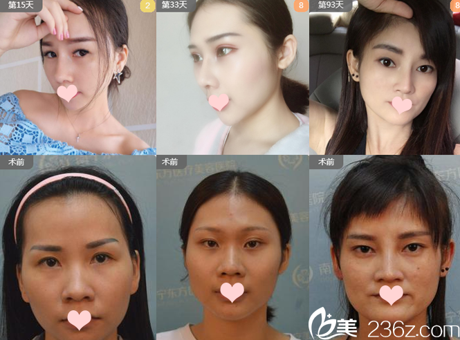 南寧東方整形醫(yī)院鼻綜合案例組圖 南寧東方整形醫(yī)院鼻綜合案例組圖