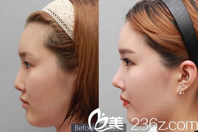 趙正杰隆鼻案例圖