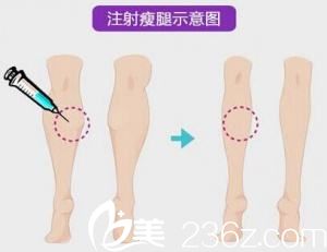 瘦臉除皺瘦腿示意圖