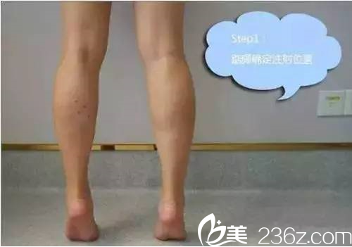 瘦腿注射找準(zhǔn)注射位置