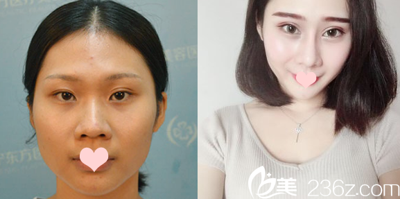 南寧東方整形醫(yī)院劉剛雙眼皮案例