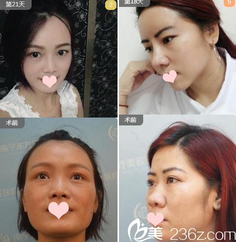 南寧東方劉剛鼻綜合案例對(duì)比組圖