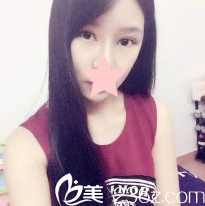 大家來看石獅栢麗整形醫(yī)院盛宗順為我做的雙眼皮好不好？