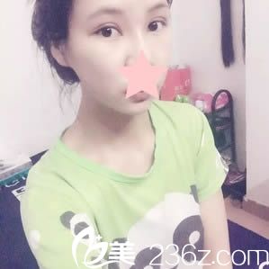 盛宗順做眼睛術(shù)后15天恢復(fù)效果