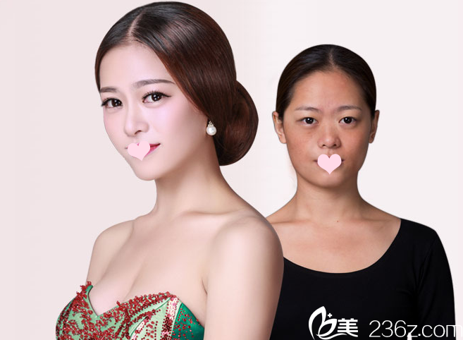 南寧東方整形醫(yī)院趙波隆胸案例對比圖 南寧東方整形醫(yī)院趙波隆胸案例對比圖