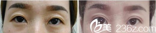 沈陽名流醫(yī)院雙眼皮平行真人<span style= 沈陽名流醫(yī)院雙眼皮平行真人<span style=
