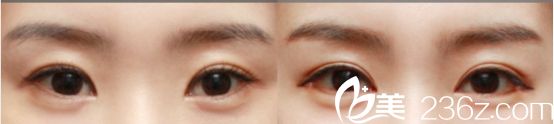 沈陽名流醫(yī)院雙眼皮自然型真人<span style= 沈陽名流醫(yī)院雙眼皮自然型真人<span style=