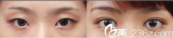 沈陽名流醫(yī)院新月型雙眼皮<span style= 沈陽名流醫(yī)院新月型雙眼皮<span style=