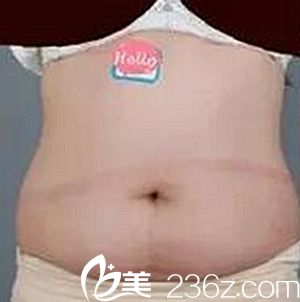 我在沈陽(yáng)茗湲做腰腹吸脂手術(shù)前.jpg 我在沈陽(yáng)茗湲做腰腹吸脂手術(shù)前.jpg