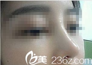 進行鼻修復(fù)手術(shù)后的鼻子