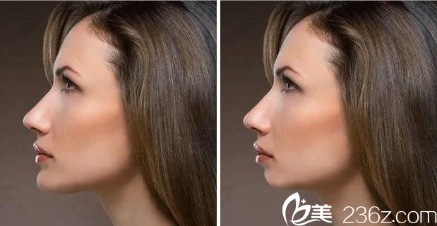 鼻子在挺，沒有下巴一樣白搭