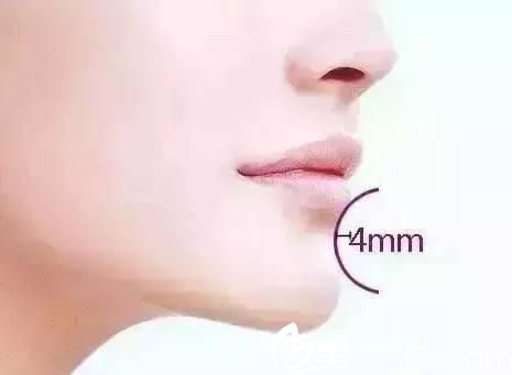 嘴唇與下巴之間有明顯的唇溝