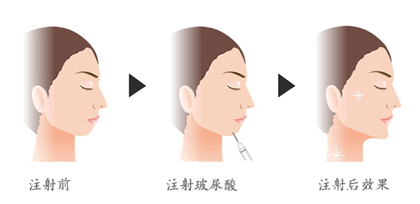 玻尿酸注射豐下巴