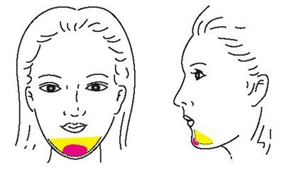 自體脂肪豐下巴