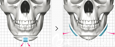 原辰切骨手術(shù)打造完美下巴