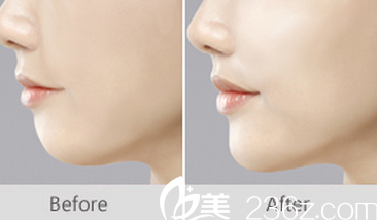 原辰墊下巴真人案例