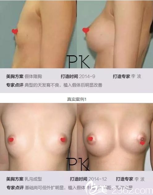 李波主任隆胸案例