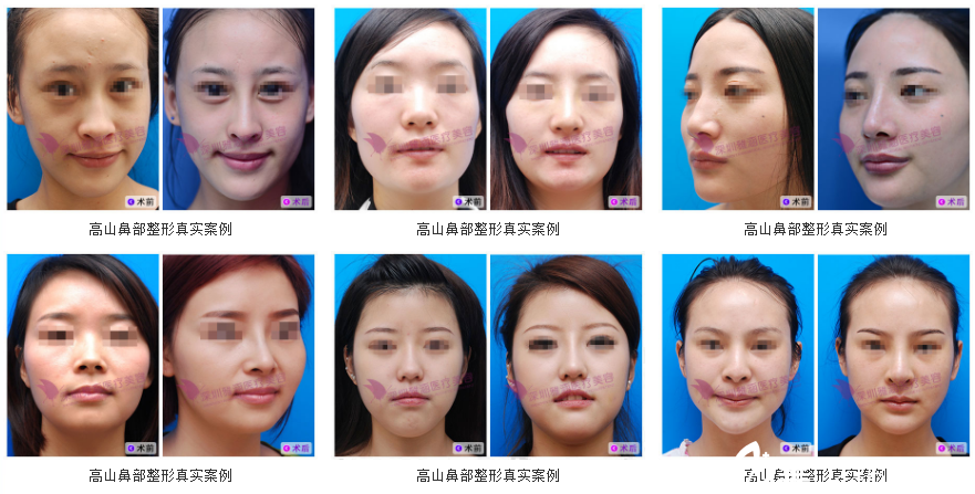 深圳隆鼻醫(yī)生高山做鼻子案 例圖 深圳隆鼻醫(yī)生高山做鼻子案 例圖