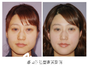 深圳雅涵醫(yī)療美容高山改臉型真實<span style= 深圳雅涵醫(yī)療美容高山改臉型真實<span style=