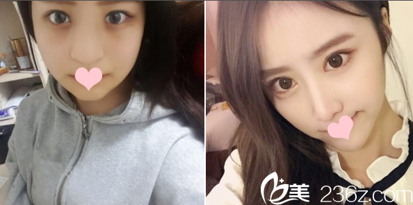 深圳雅涵侯文明隆鼻案例對(duì)比圖