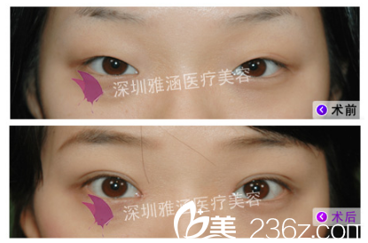 深圳雅涵侯文明修復(fù)雙眼皮案例
