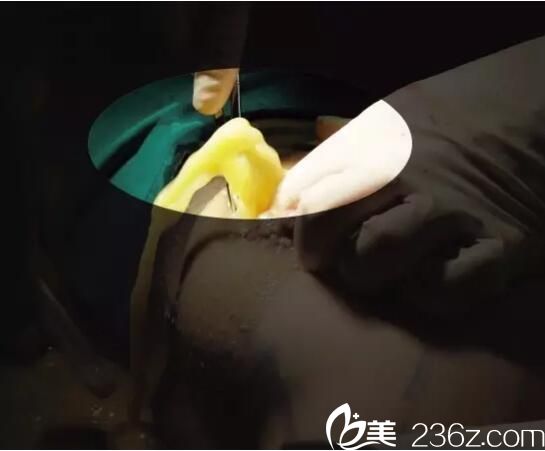 提醒2性填充物，慎選 韓楚