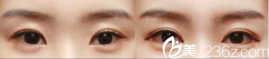 杭州愛琴海醫(yī)院雙眼皮真人案例