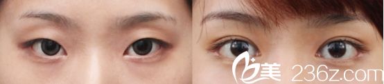 杭州愛琴海醫(yī)院雙眼皮真人案例2