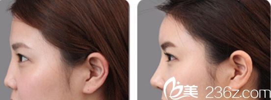 杭州愛琴海醫(yī)院隆鼻真人案例1