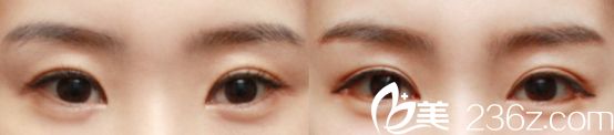 杭州愛琴海醫(yī)院雙眼皮真人案例3